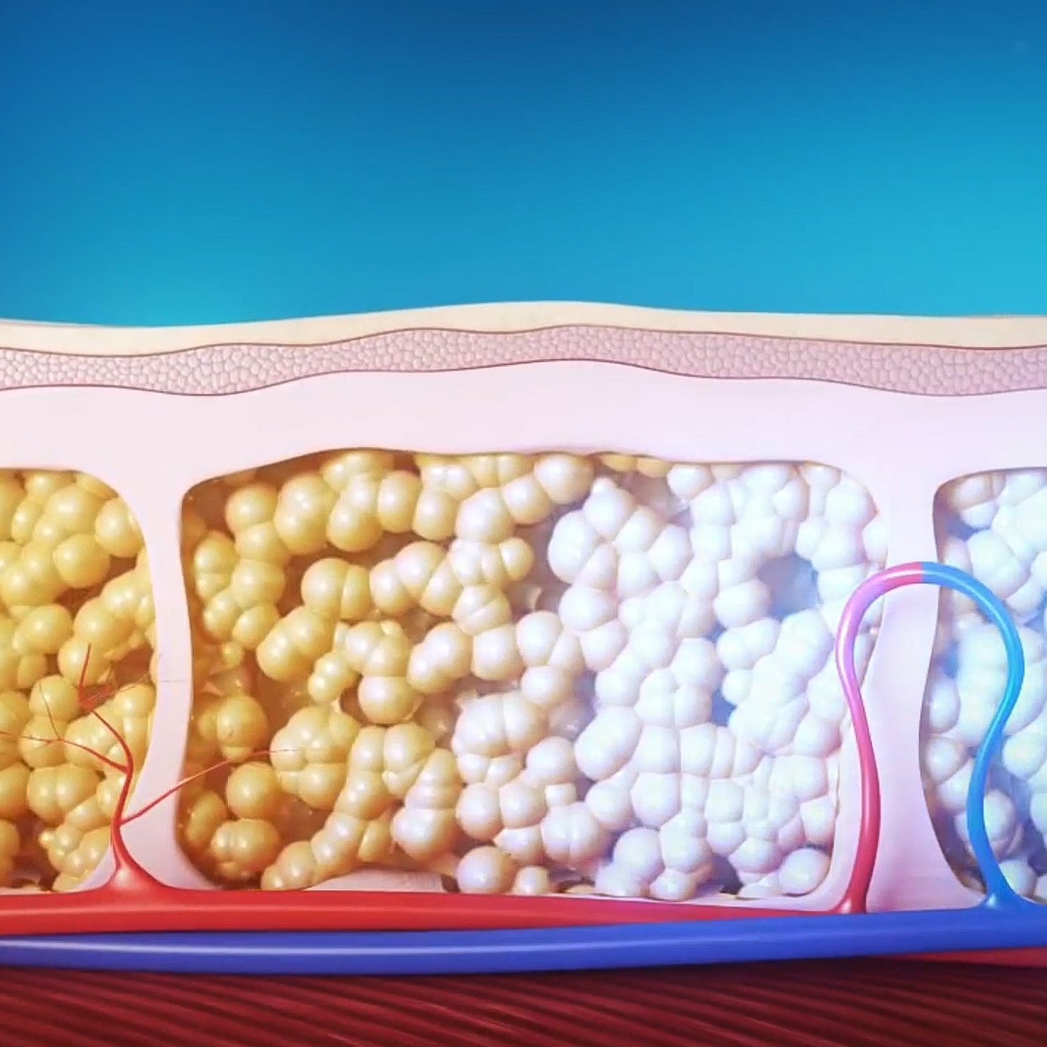 Kriolipoliza + elektrostymulacja mięśni EMS Cryo Basic - metoda działania