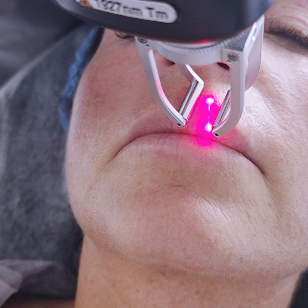 Laser Tulowy 1920 nm Thalia - rewitalizacja ust