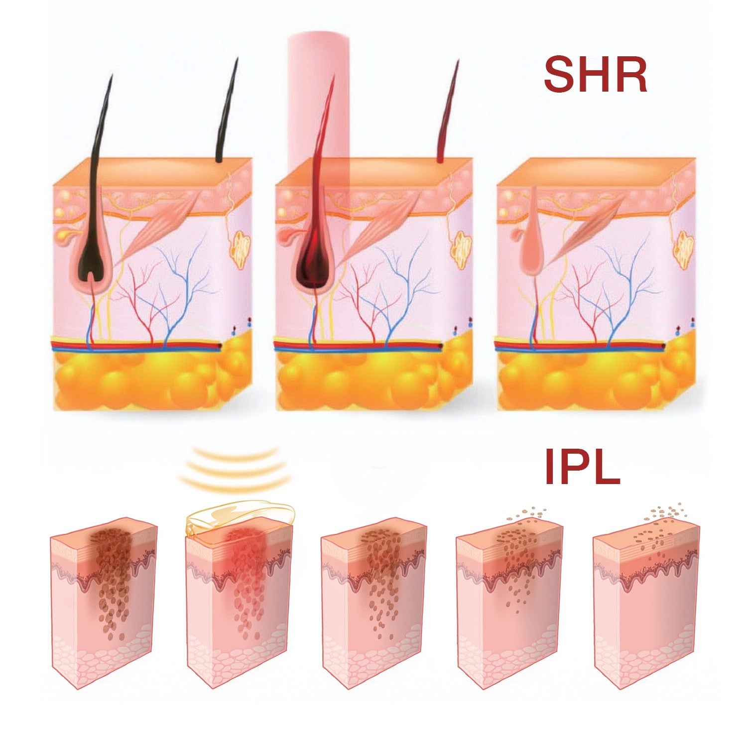 SHR IPL E-light - schemat działania